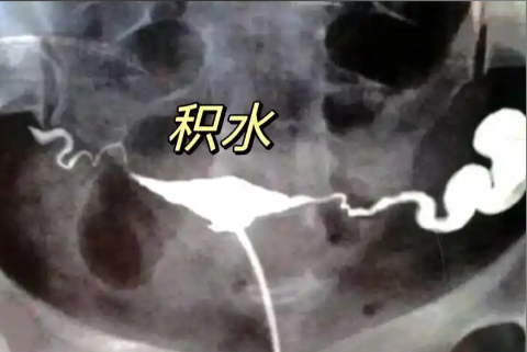 <b>【解答】做试管，什么情况下需要先处理输卵管问题！</b>