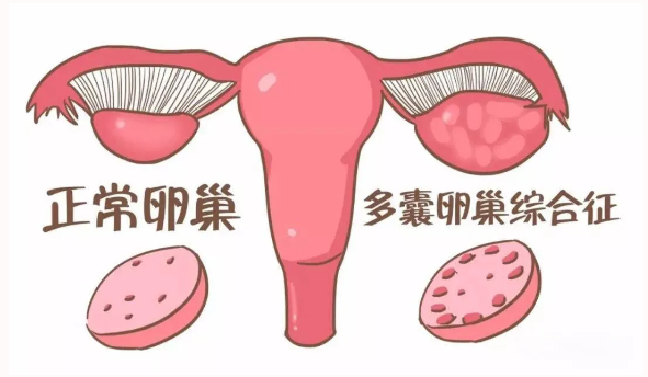 <b>收藏！多囊卵巢综合征（PCOS）试管助孕全攻略！</b>