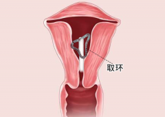 无痛取环能做吗？有没有什么副作用和风险？