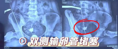 <b>输卵管堵塞患者做试管，成功率高不高？</b>