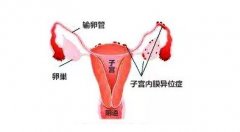 ‌子宫内膜异位3期的严重性解析：症状、影响与治疗