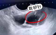 试管取卵后出现腹水怎么处理？什么时候可以移植？