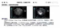 子宫内膜异位症合并免疫紊乱妈妈的458天试管长征